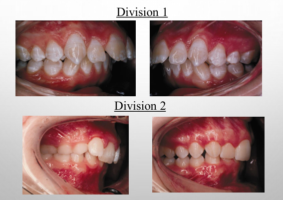 <p>-class II division 1: maxillary anterior teeth are proclined and a large overjet is present</p><p>-class II division 2: maxillary anterior teeth are retroclined and a deep overbite exists</p>