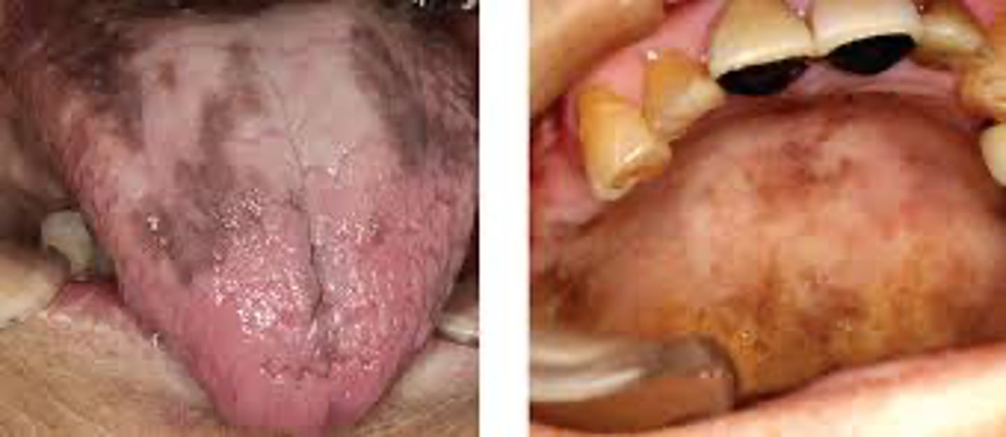 <p>A patient presents with multiple flat brown macules on the lips, oral mucosa, and perioral skin. The pigmentation is diffuse and symmetric, with no single dominant lesion.</p><p>Which of the following is MOST likely to be considered in the differential diagnosis?</p>
