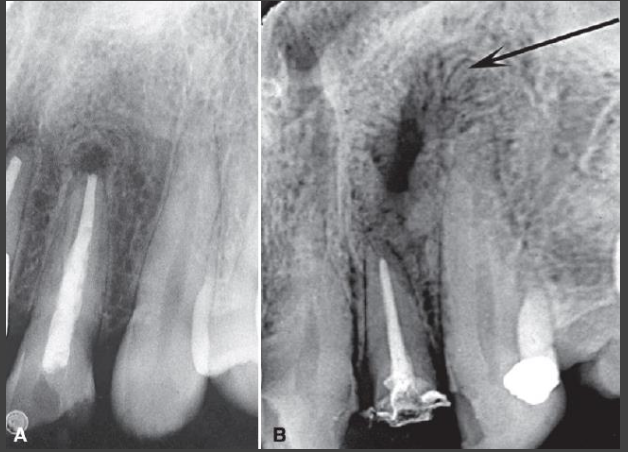 <ul><li><p>Periapical scar – fibrous healing defect</p></li><li><p>Pattern of healing bone</p></li><li><p>Compare imaging over time</p></li><li><p>Clinical signs/symptoms</p><ul><li><p>Asymptomatic</p></li></ul></li></ul><p></p>