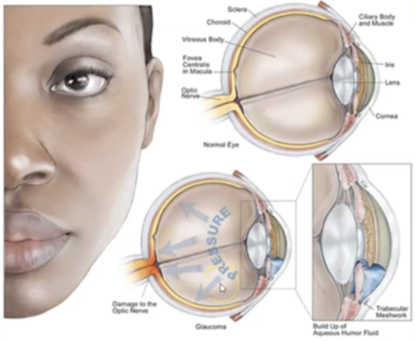 <p>What is Glaucoma?</p>