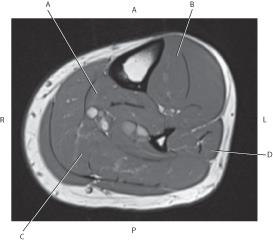 <p><mark data-color="yellow">Which line is pointing to the soleus muscle?</mark></p>