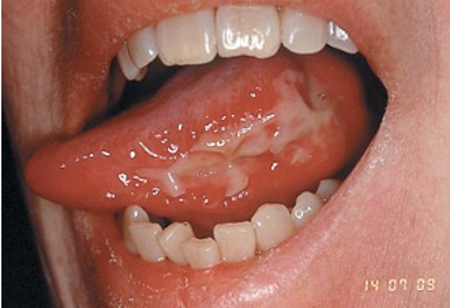 <p>Mucositis to the extend that alimentation is not possible</p><p>patient cannot eat/drink</p><p>LIFE-THREATENING</p><p>*considered severe mucositis</p>