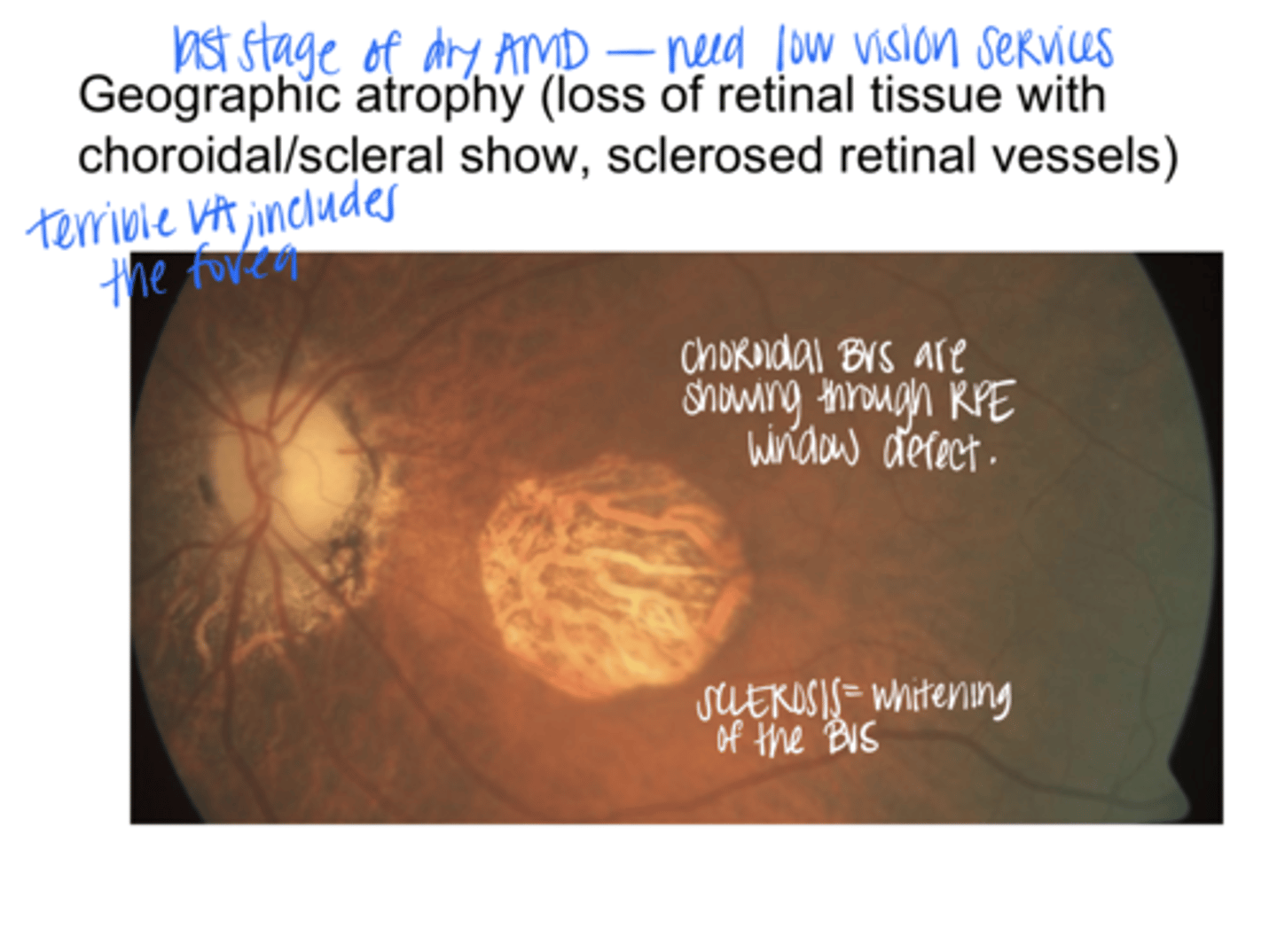 <p>What is the end stage of Dry AMD?</p>