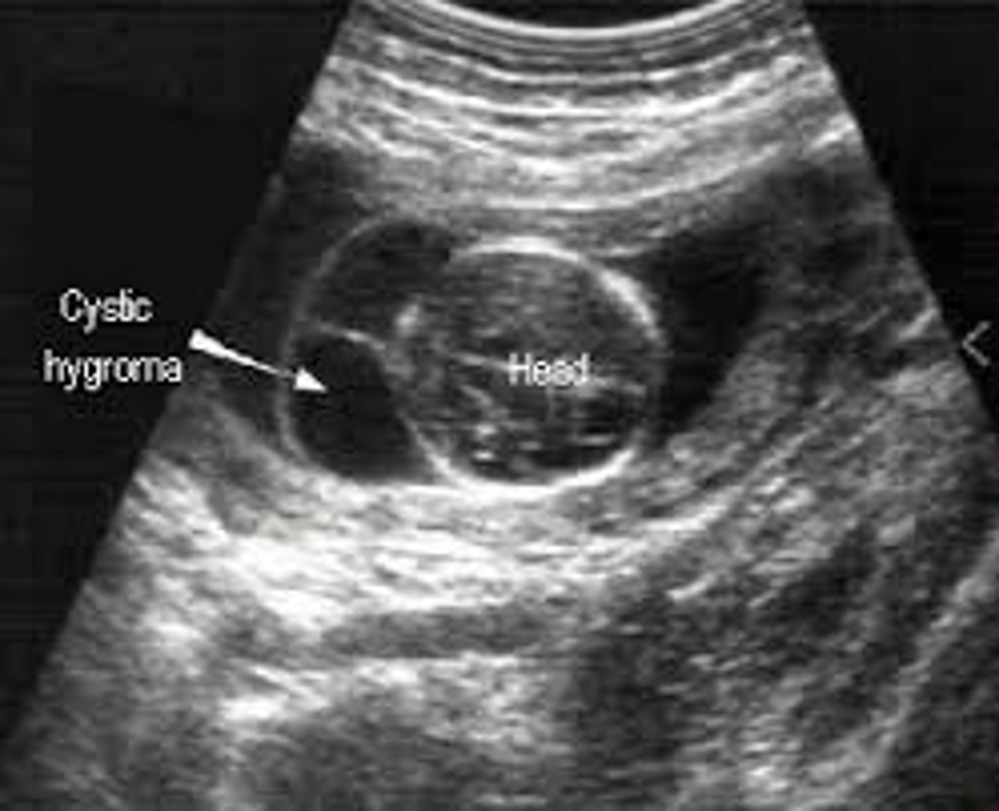 <p>Most common neck mass</p><p>Abnormal connection of lymphatic vessels</p><p>Associated with Turner's syndrome &amp; aneuploidies</p>