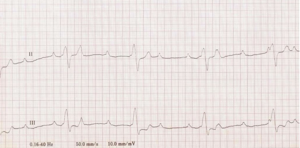 <p>What type of arrhythmia is demonstrated in this case?</p>