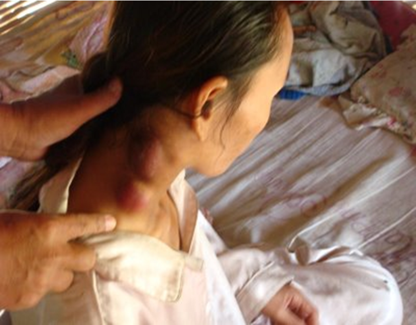 <p>granulomatous neck masses, single or matted nodes; could be painful or painless; may not respond to abx</p>