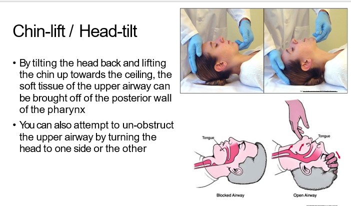  

•By tilting the head back and lifting  the chin up towards the ceiling, the  soft tissue of the upper airway can  be brought off of the posterior wall  of the pharynx

•You can also attempt to un-obstruct  the upper airway by turning the  head to one side or the other
