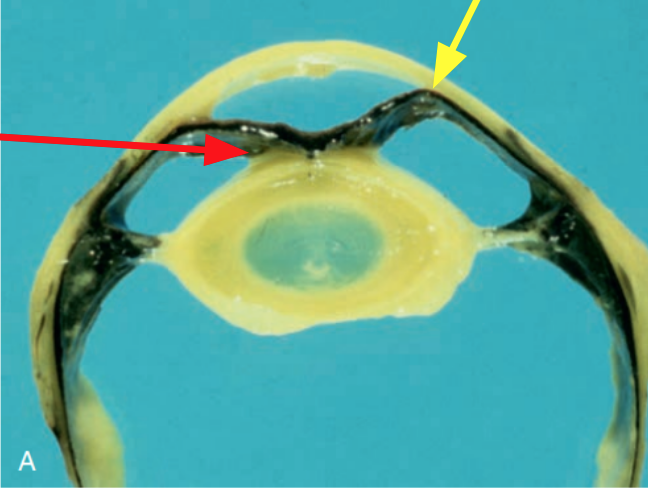 <p><span style="background-color: transparent;">What is the pathology indicated by the red arrow?</span></p>