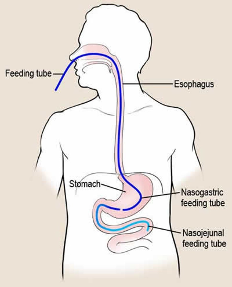 <p>Nasojejunal tube (nose to jejunum)</p>
