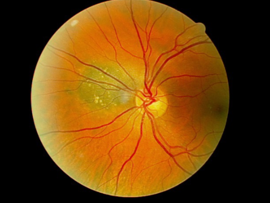 <p>what is the concern for this being melanoma? </p>