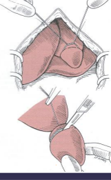 <p><span>Surgical Techniques and Considerations of the Liver</span></p>