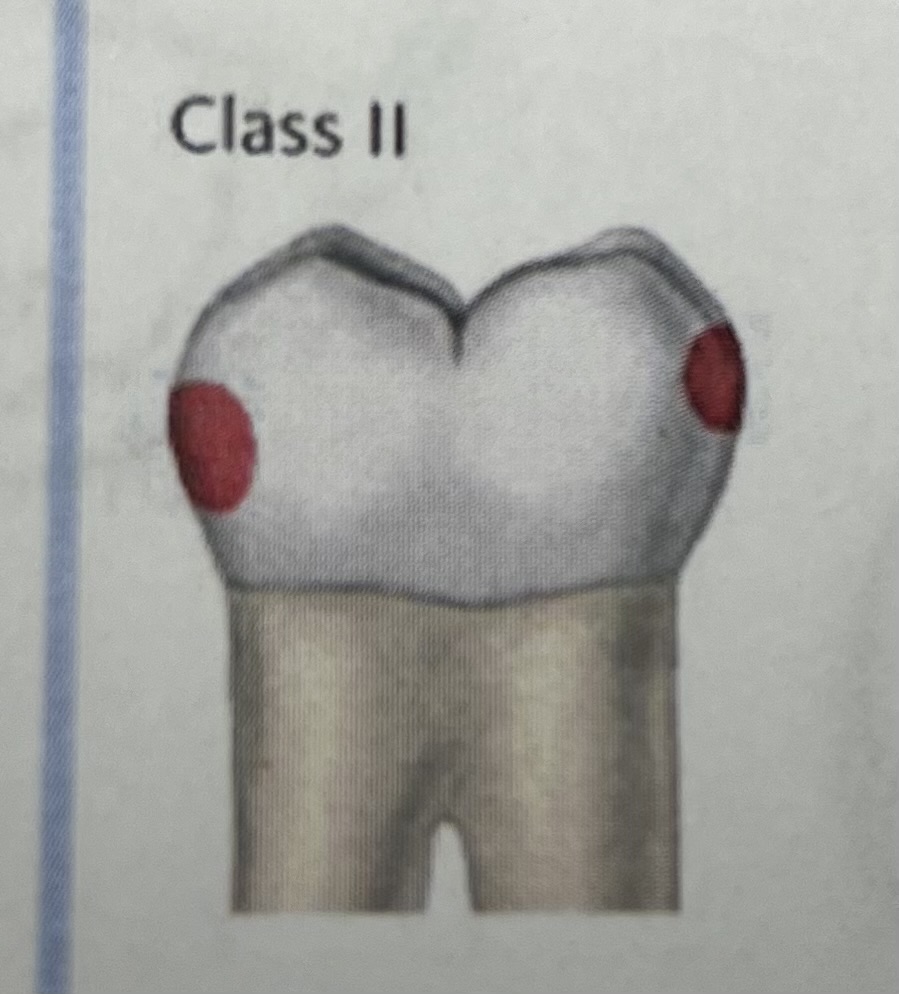 <p>Decay on Proximal mesial or distal surfaces of PREMOLARS and MOLARS</p>