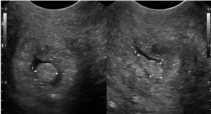 <p>• Present clinically with irregular bleeding.</p><p class="p1">• Benign condition arises from the hyperplastic protrusion of <em>epithelium of</em></p><p class="p1"><em>endocervix or ectocervix.</em></p><p class="p1">• Chronic inflammation most likely factor</p><p class="p1">• Polyps may be pedunculated, projecting out of cervix, or broad-based.</p><p class="p1">• <em>Ultrasound may or may not see cervical polyps, depending on location.</em></p>