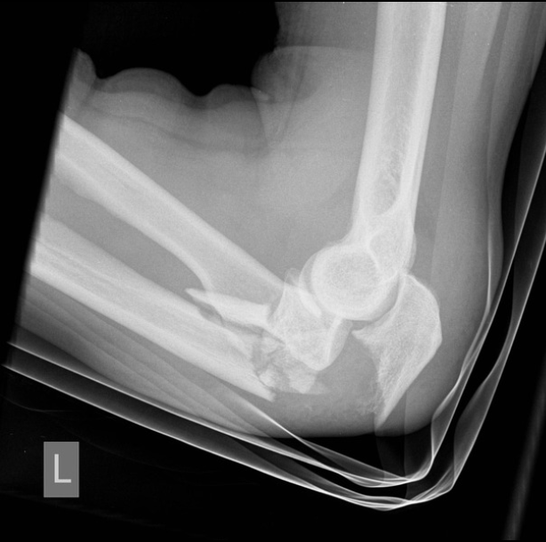 <p>If the olecranon breaks what do you lose</p>