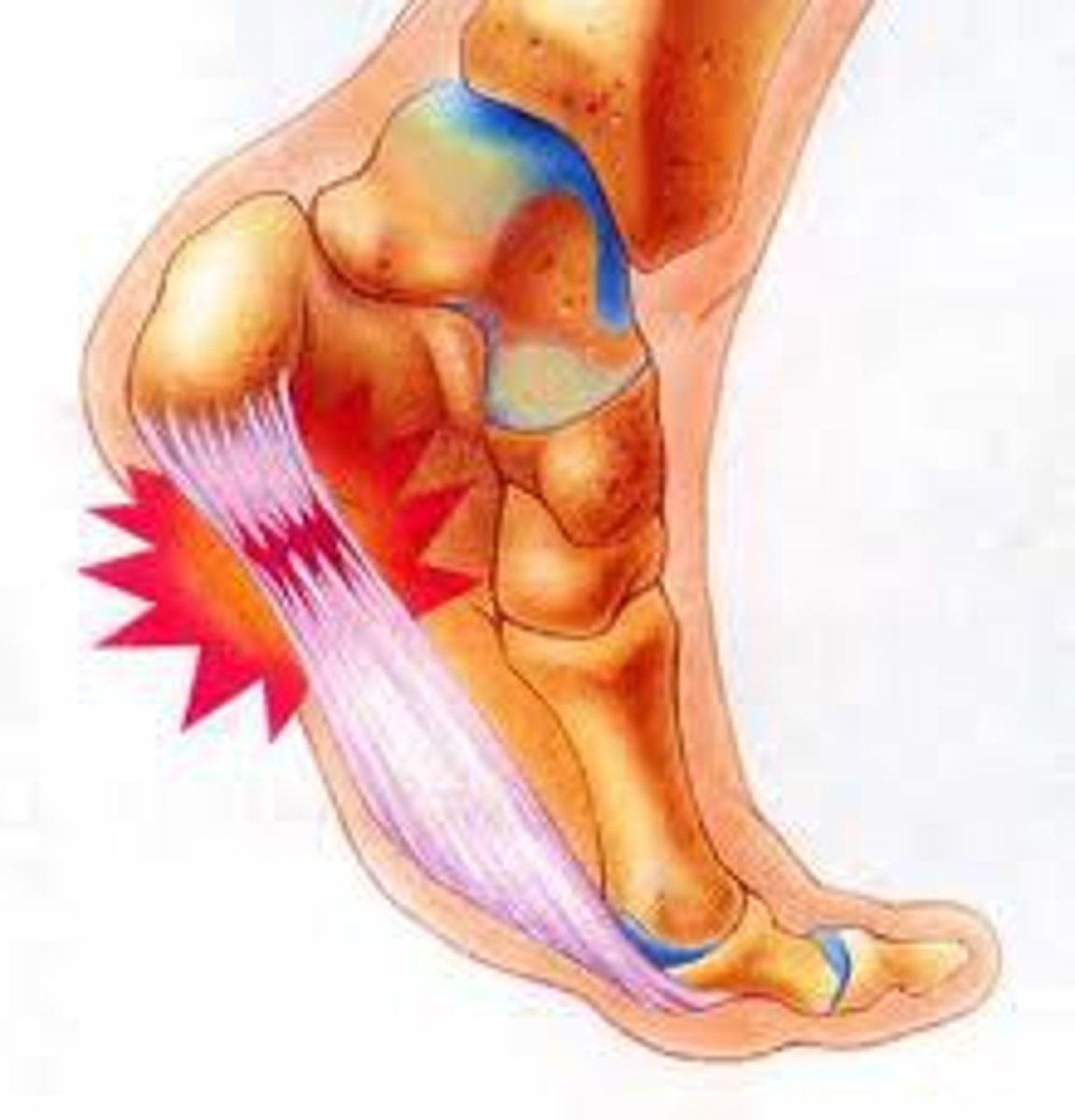 <p>irritation at the insertion of the plantar fascia on the calcaneal tuberosity</p><p>- resulting from microtrauma to the plantar fascia (poor fitting shoes, improper gait)</p><p>- presents with intense sharp pain at calcaneal tuberosity with first couple steps in the morning and after long periods of non-weight bearing</p><p>- pain will decrease with initiation of movement</p><p>- palpation is painful with passive extension of digits</p>