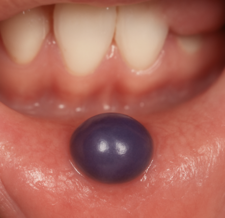 <p>Dit is een speekselkliercyste van de kleine speekselklier. Dit is een blauwachtig blaasje op de onderlip of op de mucosa. Het kan in principe overal in de mondholte voorkomen waar speekselklieren zitten. Het slijm hoopt zich op en er ontstaat een cyste. In 90% van de gevallen zijn het pseudocysten, deze zijn niet bekleed met een epitheel laag).</p>