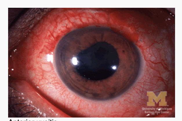 <p>Anterior Uveitits</p>