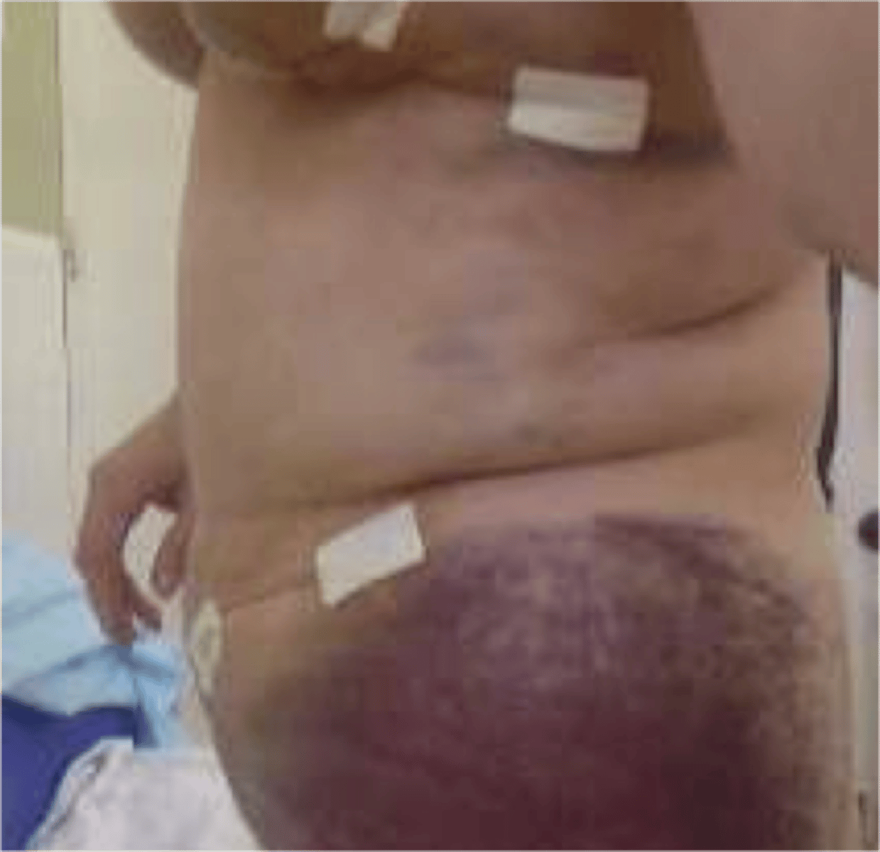 <p>wound edges not approximated ex: surgical wounds that have tissue loss or contamination</p>