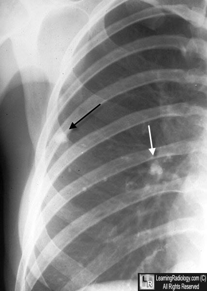 <p>They develop into <strong>caseous lesions</strong> that have a <strong>cheese like consistency </strong>and can <strong>calcify into hardened Ghon complexes </strong>seen on X-rays.</p>