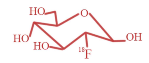 <p>Le <span style="color: red"><strong>18F-FDG (18F-fluorodéoxyglucose)</strong></span> est un médicament radiopharmaceutique. C’est du fluorodéoxyglucose radiomarqué au fluor 18. C’est un<strong> analogue du glucose</strong> sauf que sur une position, on a un fluor au lieu d’un hydroxyle. Il est capté par les transporteurs GLUT des cellules mais il ne peut pas ressortir ce qui permet d’avoir une imagerie indirecte des <strong>cellules ou des sites qui consomment beaucoup de glucose.</strong> </p>