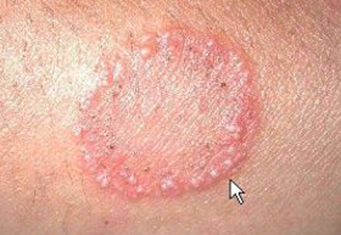 <p>highly contagious fungal infection marked by raised, itchy, circular patches with crust</p>