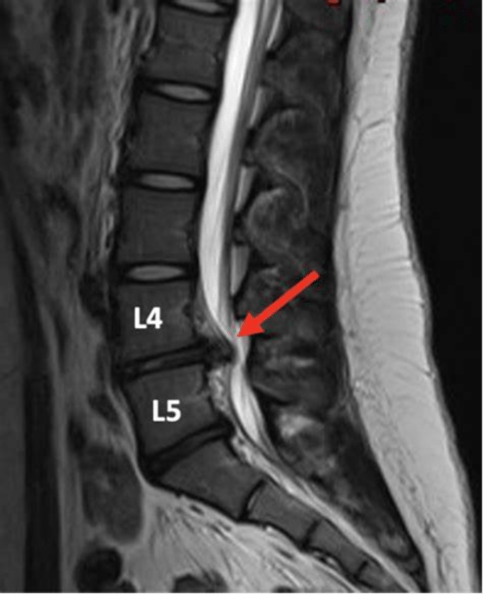<p>mild-severe pain, paresthesia, and muscle weakness</p>