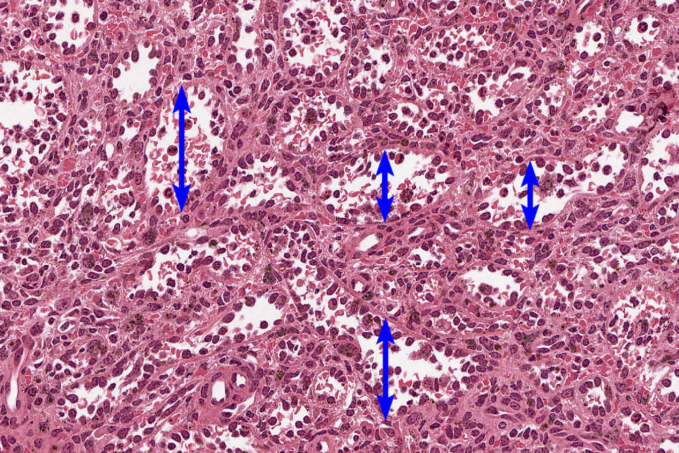 <p><span style="color: rgb(38, 38, 38)">unique sinusoidal vessels lined by highly elongated endothelial cells with large nuclei that bulge into the sinus lumen.</span></p>