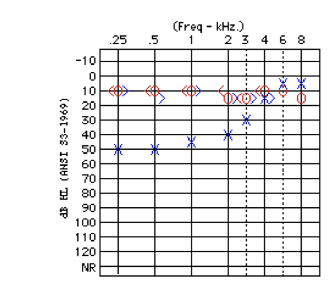 <p>- when the air conduction threshold in the test ear minus the inter aural attenuation value is greater than or equal to the bone conduction threshold in the non-test ear, cross hearing is a threat to the validity of the results for the test ear.</p><p>if AC(TE) - BC(NTE) ≥ 40 then cross hearing is threat, and the threshold isn't real, and if masked, it would be significantly lower.</p>