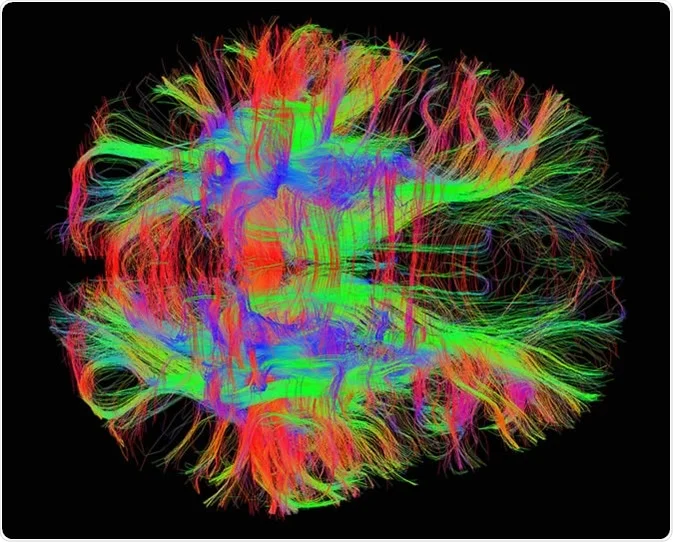 <p>type of MRI that measures the movement of water molecules in tissue to create detailed images of brain and spinal cord</p><ul><li><p>difference in how water moves parallel to and perpendicular to nerve fibres (diffusion anisotropy)</p></li><li><p>detailed images of brain’s white matter, direction of diffusion flow (identifies injuries and abnormalities)</p></li><li><p>Diagnoses stroke, brain tumours, MS, TBIs, concussions</p></li><li><p>More detailed than standard MRI - shows actual nerve tract</p></li><li><p>helpful for white matter disorders - schizophrenia, psychopathy</p></li></ul><p></p>