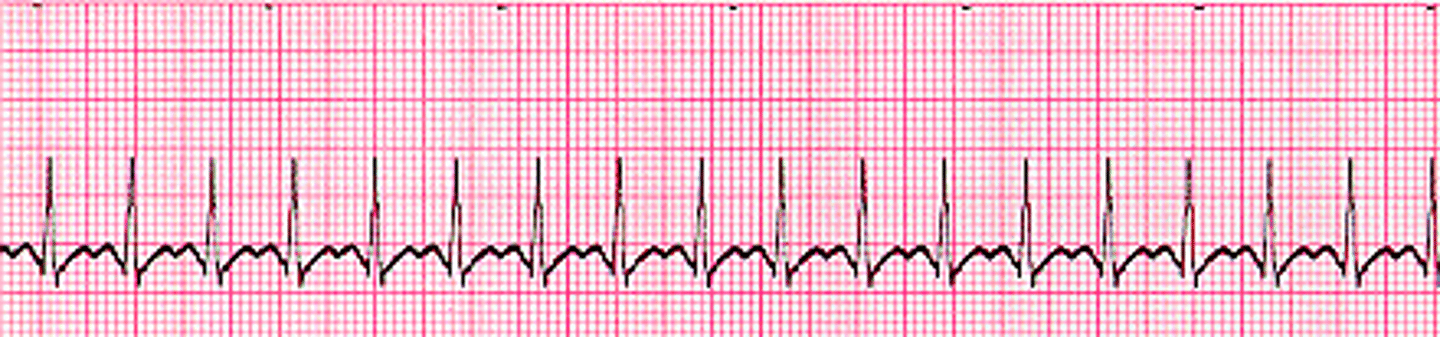 <p>Vagal manuever.</p>