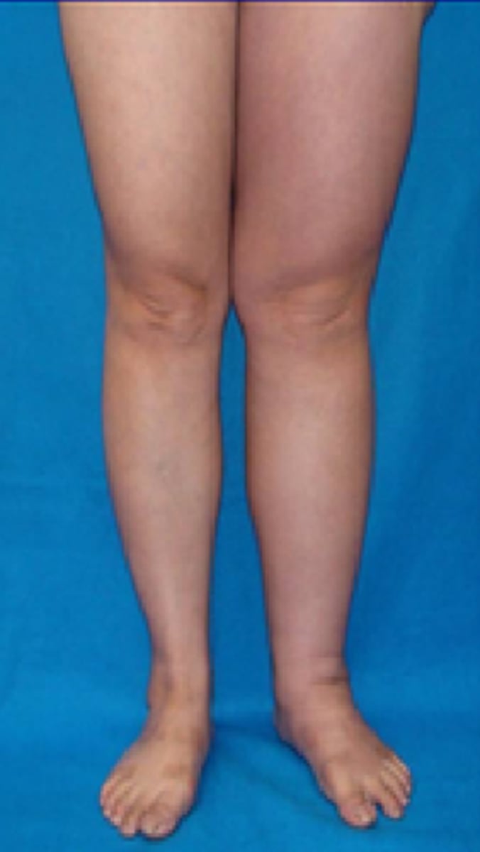 <p>Reversible, limb is soft and pitting, swelling may increase overnight</p>