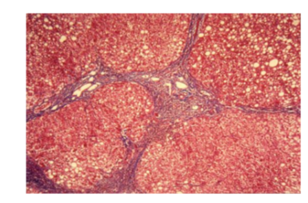 <ul><li><p>See fat globules</p></li><li><p>Disruption in the triad</p></li><li><p>Border lining of each of these hepatocytes are not very clear</p></li><li><p>Structural changes will affect function</p></li></ul><p></p>