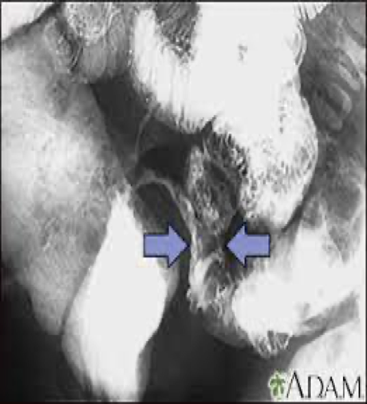 <p>Can cause weight loss, anemia, bleeding</p>