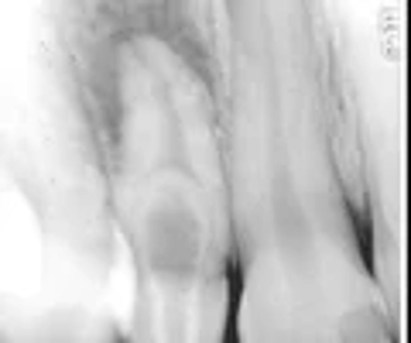 <p>Dens in dente</p>