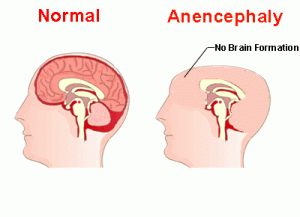 <ul><li><p>Absence of cerebral hemispheres </p></li><li><p>Brainstem function may be intact </p></li><li><p>Incompatible with life:</p><ul><li><p>survive only a few hours/days and die due to respiratory failure</p></li></ul></li></ul>