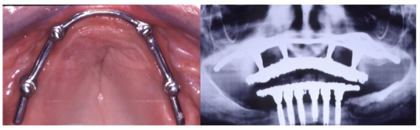 <p>What type of implant?</p>