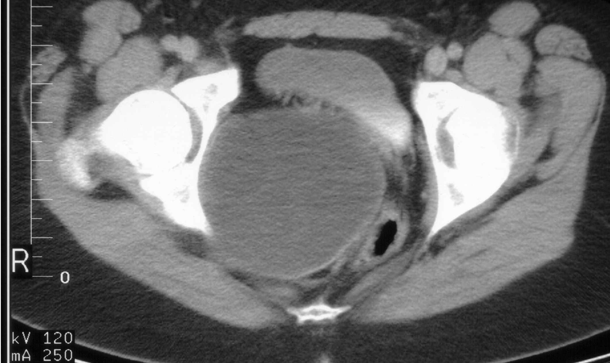 <p>18 y/o with amenorrhea has CT scan shown…what it is it? </p>