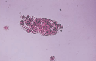 A stained WBC cast showing its nuclei