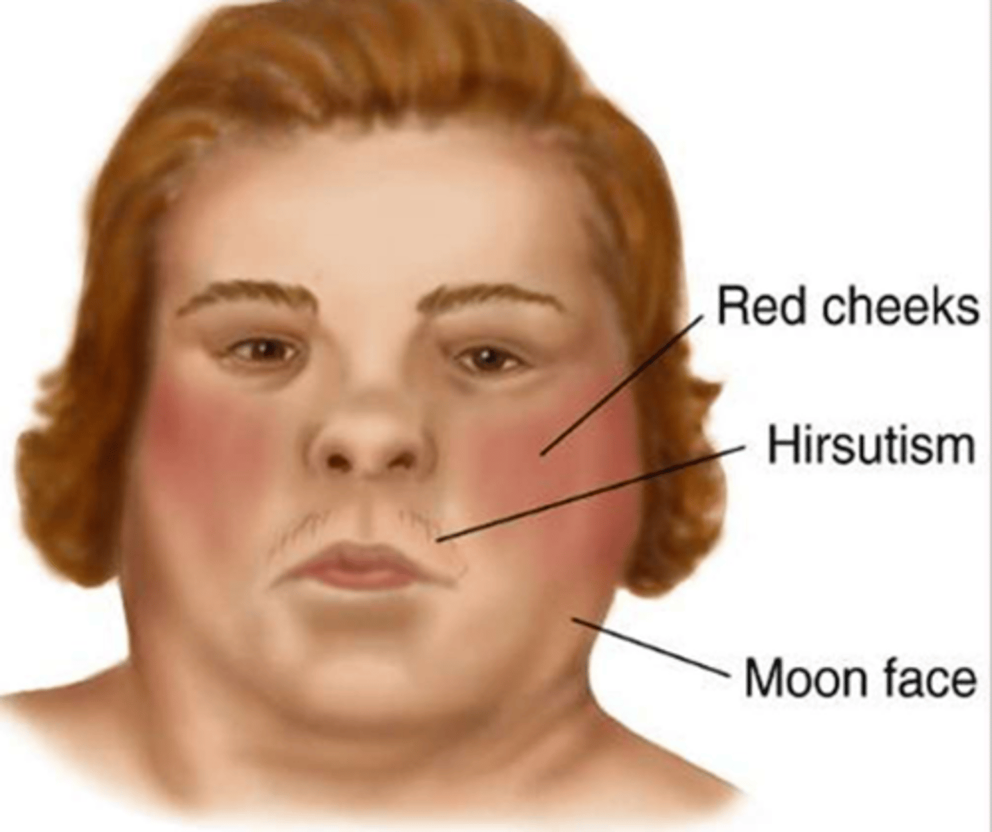 <p>moon face</p><p>red cheeks</p><p>hirsutism</p>