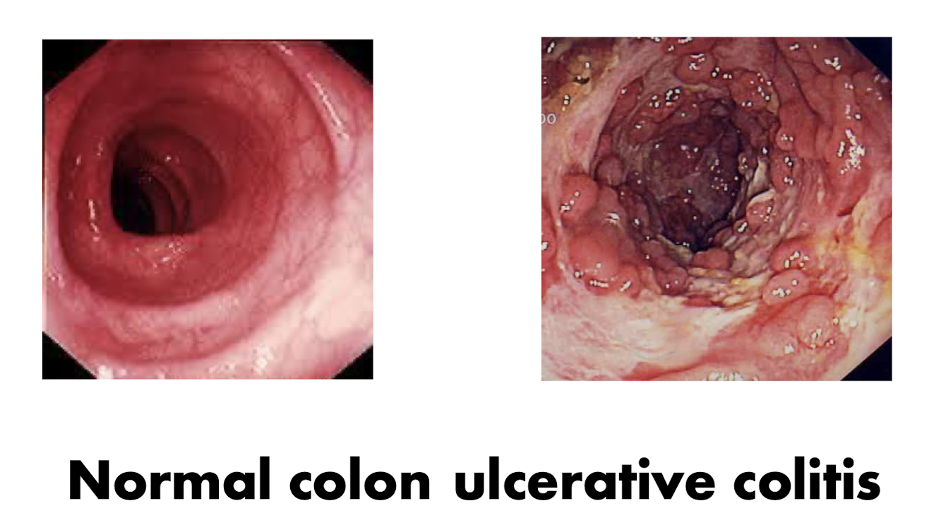 <p>Inflammatory Bowel Disease (IBD):</p><ul><li><p>What is IBD?</p><ul><li><p>2 Common IBD Diseases:</p></li></ul><p></p></li></ul><p></p>
