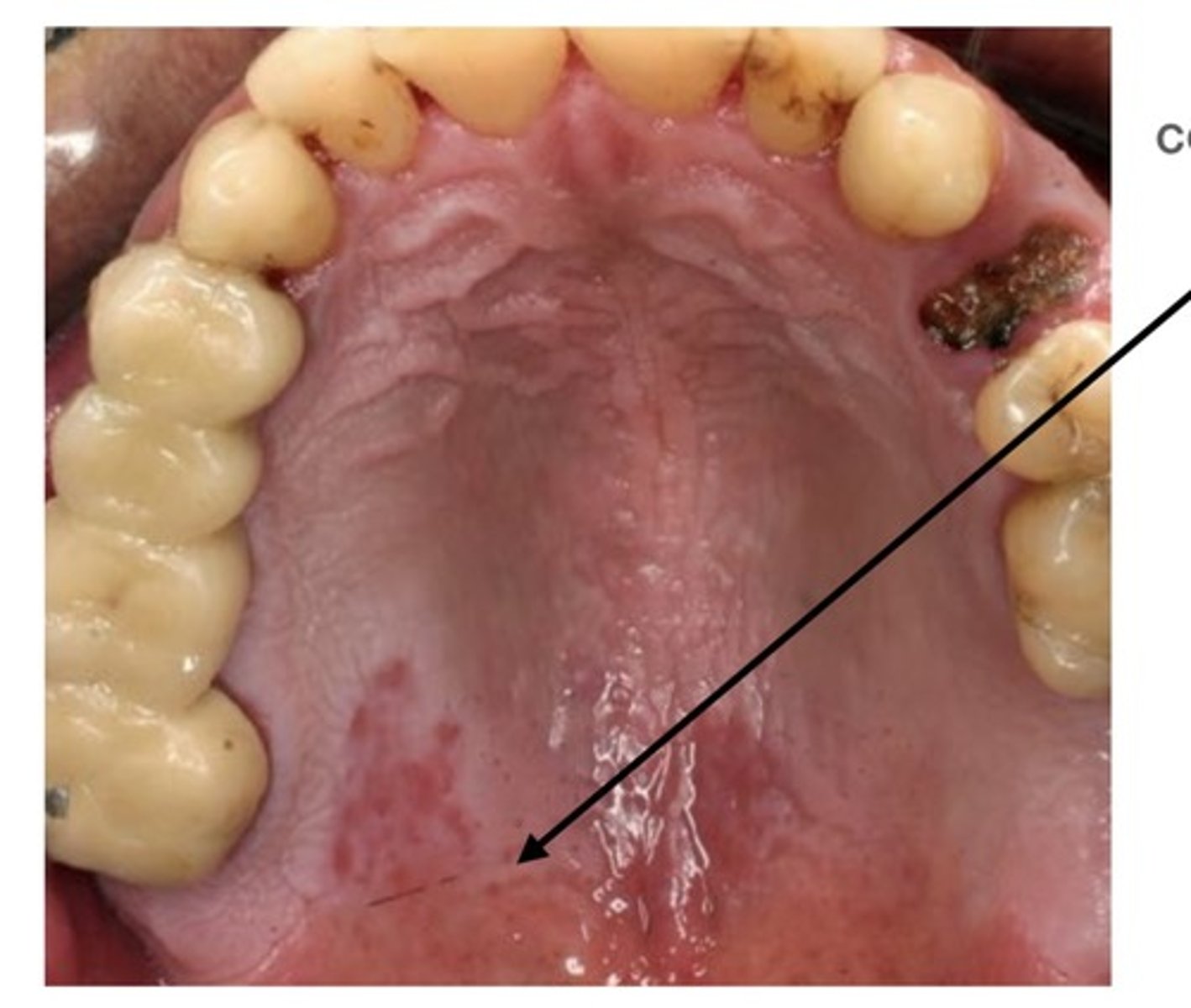 <p>Inflammation of the roof of the mouth</p>