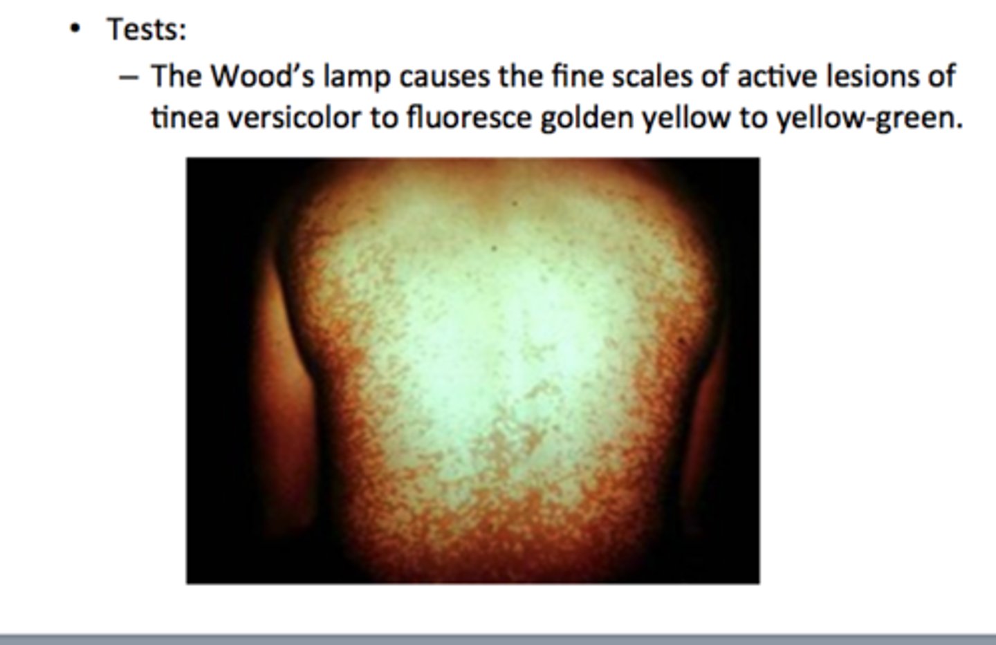 <p>-KOH prep from skin scraping showing hyphae and spores</p><p>-Woods lamp showing yellow-green fluorescence over affected spots</p><p>tx: topical antifungals: selenium sulfide, sodium sulfacetamide, zinc pyruthione, and "azoles"</p><p>if failed topicals: systemic antifungal therapy with itraconazole or fluconazole</p>