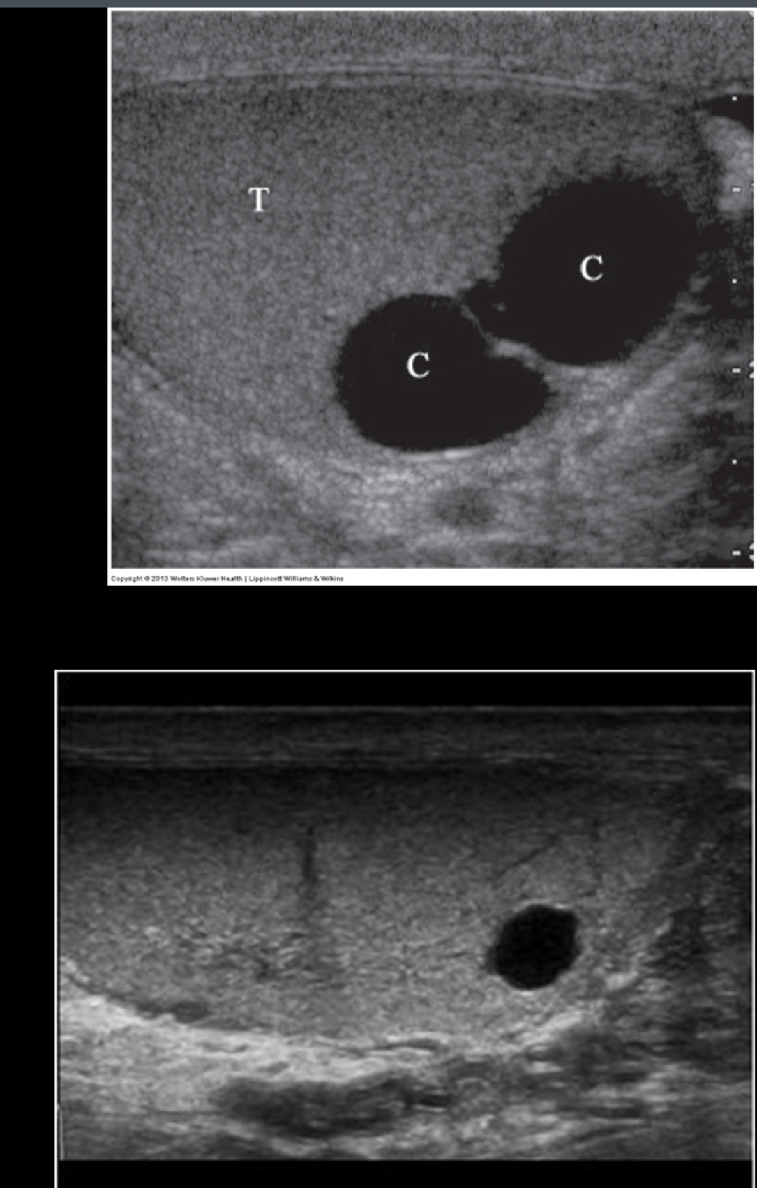 <p>What does the following describe?</p><ul><li><p><span>﻿﻿Discovered incidentally, occur in 8-10% of patients, two types</span></p></li><li><p><span>﻿﻿Cysts of tunica albuginea</span></p></li><li><p><span>﻿﻿Intratesticular cysts- Normally located near mediastinum testis &amp; probably originate from rete testis</span></p></li></ul>