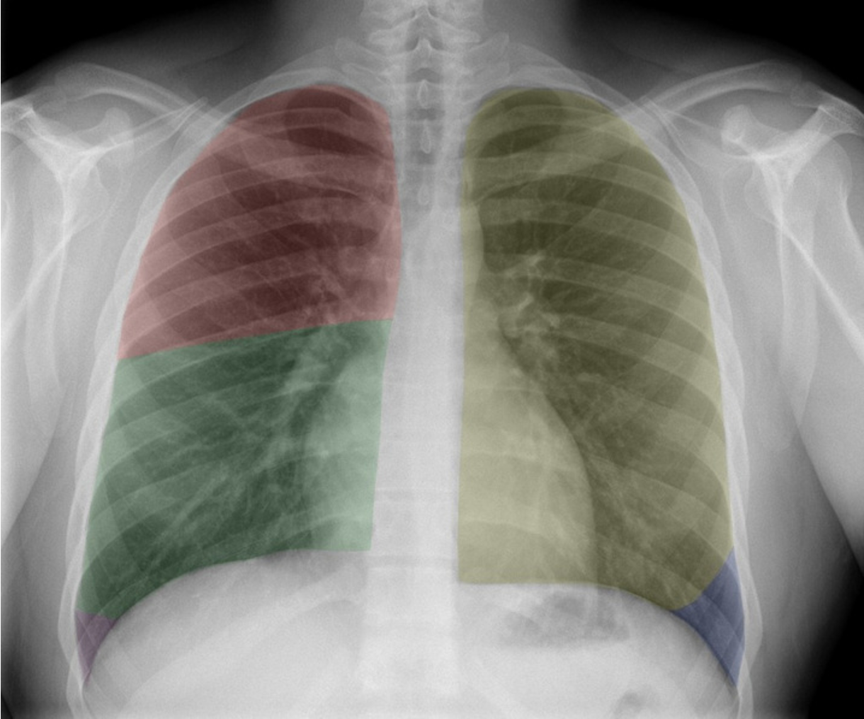 <p>Name the lung lobes according to color </p>