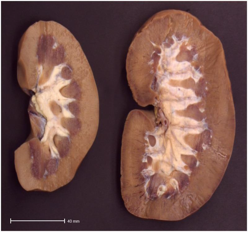 <p>Double size of kidney upon the removal of one</p>