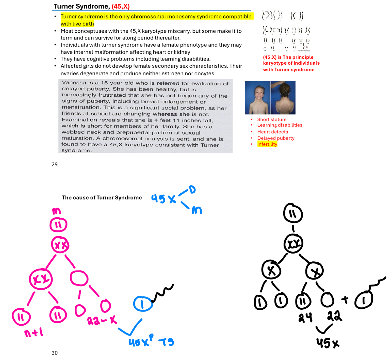 <p>A chromosomal disorder in females caused by the absence of one X chromosome (monosomy) (45,X), leading to various developmental issues.</p><p><strong>Turner syndrome is the only chromosomal monosomy suyndrome compatible with live birth</strong></p><p>Most conceptuses with 45,X karytoype miscarry</p>