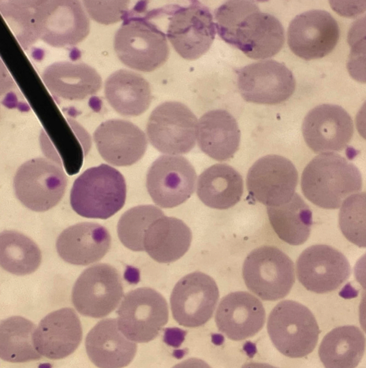 <p>A. Identify the pointed cell</p><p>B. Describe the striking feature</p><p>C. What represents the inclusion of this cell?</p><p>D. Give associated condition</p>
