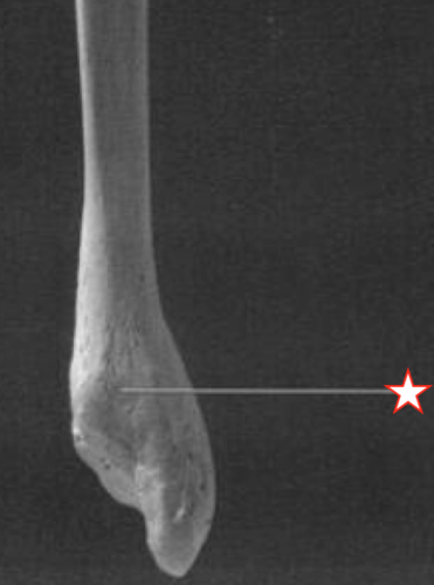 <p>for tendons of the fibularis longus and fibularis brevis muscles, marks posterior surface of distal FIBULA</p>