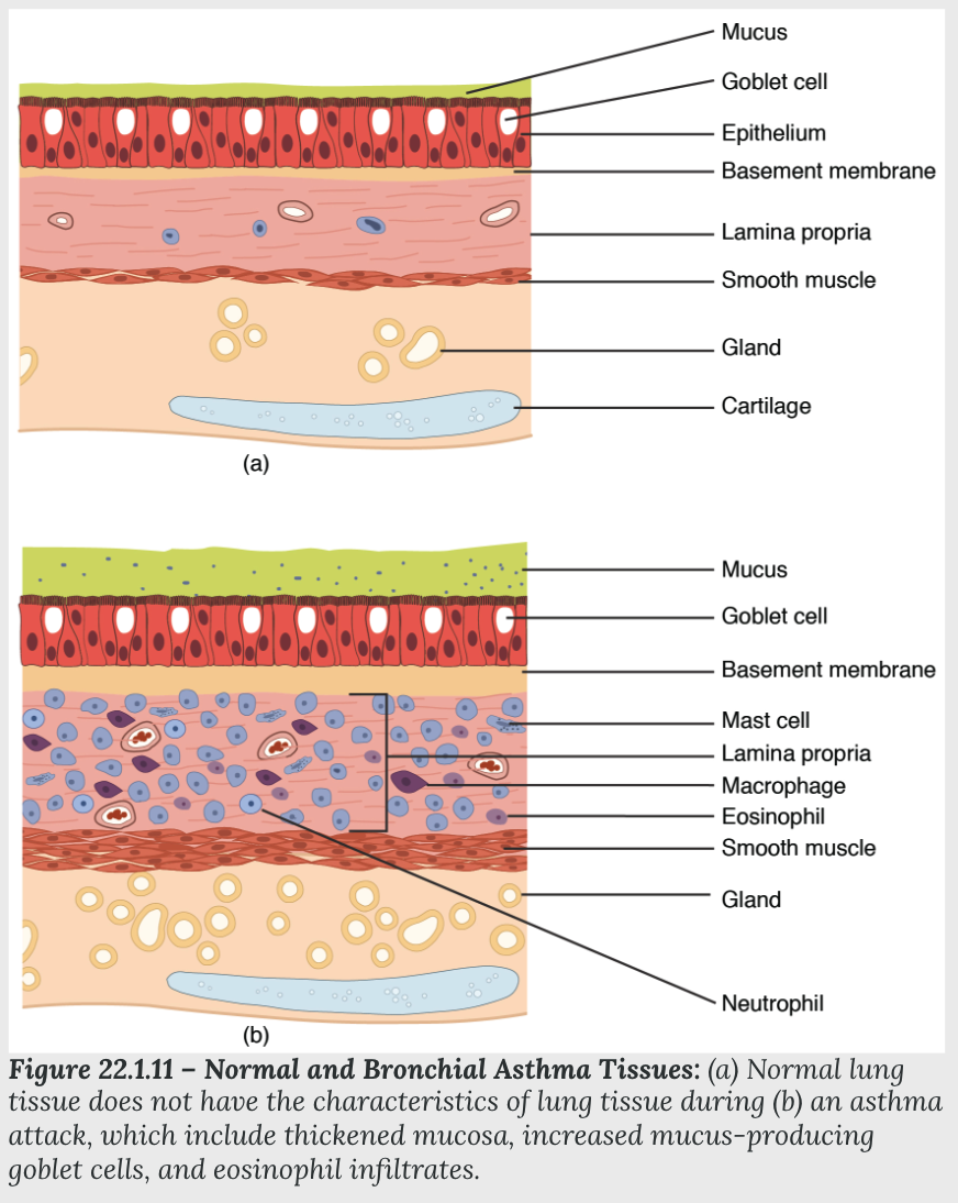 <p><strong>Asthma</strong></p><ul><li><p>inflammation and ____ of the airway, and _______ (that is, constriction of the bronchioles), which can inhibit air from entering the lungs</p><ul><li><p><strong>thickened mucosa, increased mucus-producing goblet cells, and eosinophil infiltrates</strong></p></li></ul></li><li><p>Bronchospasms occur periodically and lead to an “asthma attack.”</p></li><li><p>Triggered by dust, pollen, pet hair, or dander, changes in the weather, mold, tobacco smoke, and respiratory infections, or by exercise and stress</p></li></ul>