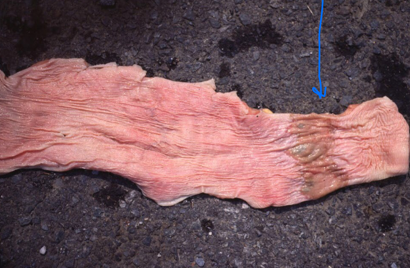 <p>This circumferential damage to the esophagus indicates what?</p>